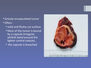  Grossly encapsulated tumor
 Often:
   solid and fleshy cut surface.
   Most of the tumor is bound
    by a capsule (irregular
    whitish band around the
    lighter central nodule).
   the capsule is breached
 