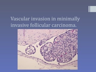 Vascular invasion in minimally
invasive follicular carcinoma.
 