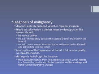  Diagnosis of malignancy:
  depends entirely on blood vessel or capsular invasion
  blood vessel invasion is almost never evident grossly. The
   vessels should:
    be venous caliber
    be in or immediately outside the capsule (rather than within the
     tumor)
    contain one or more clusters of tumor cells attached to the wall
     and protruding into the lumen
  interruption of the capsule must be full thickness to qualify
   as capsular invasion
  distinguish foci of capsular invasion:
    from capsular rupture from fine needle aspiration, which results
     in a fissure-like quality with foci of recent or old hemorrhage and
     florid stromal reparative changes
 