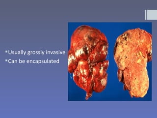  Usually grossly invasive
 Can be encapsulated
 