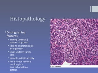 Histopathology

 Distinguishing
  features:
   nesting (‘insular’)
    pattern of growth
   solid-to-microfollicular
    arrangement
   small uniform tumor
    cells
   variable mitotic activity
   fresh tumor necrosis
    resulting in a
    peritheliomatous
    pattern
 