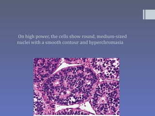 On high power, the cells show round, medium-sized
nuclei with a smooth contour and hyperchromasia
 