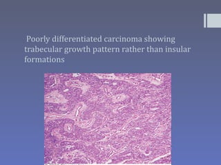 Poorly differentiated carcinoma showing
trabecular growth pattern rather than insular
formations
 