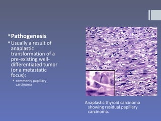 Pathogenesis
 Usually a result of
  anaplastic
  transformation of a
  pre-existing well-
  differentiated tumor
  (or a metastatic
  focus):
   commonly papillary
    carcinoma



                         Anaplastic thyroid carcinoma
                          showing residual papillary
                          carcinoma.
 
