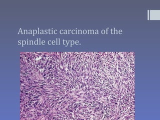 Anaplastic carcinoma of the
spindle cell type.
 