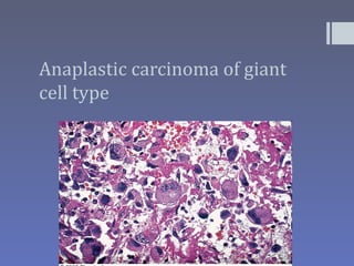 Anaplastic carcinoma of giant
cell type
 