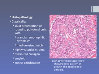  Histopathology
 Classically:
    solid proliferation of
     round to polygonal cells
     with:
      granular amphophilic
       cytoplasm
      medium-sized nuclei
    highly vascular stroma
    hyalinized collagen
    amyloid
                                Low-power microscopic view
    coarse calcification         showing solid pattern of
                                  growth and deposition of
                                  amyloid.
 
