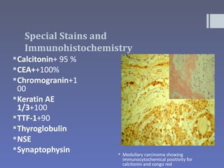 Special Stains and
   Immunohistochemistry
 Calcitonin+ 95 %
 CEA++100%
 Chromogranin+1
  00
 Keratin AE
  1/3+100
 TTF-1+90
 Thyroglobulin
 NSE
 Synaptophysin       Medullary carcinoma showing
                       immunocytochemical positivity for
                       calcitonin and congo red
 
