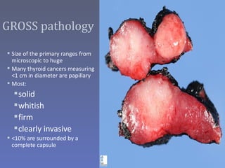 GROSS pathology

 Size of the primary ranges from
  microscopic to huge
 Many thyroid cancers measuring
  <1 cm in diameter are papillary
 Most:
   solid
   whitish
   firm
   clearly invasive
 <10% are surrounded by a
  complete capsule
 