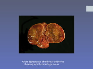 Gross appearance of follicular adenoma
 showing focal hemorrhagic areas
                          
 