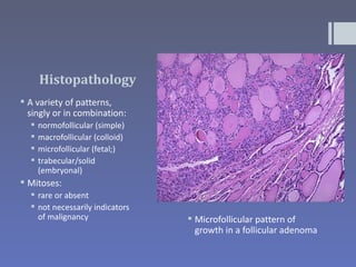 Histopathology
 A variety of patterns,
  singly or in combination:
     normofollicular (simple)
     macrofollicular (colloid)
     microfollicular (fetal;)
     trabecular/solid
      (embryonal)
 Mitoses:
   rare or absent
   not necessarily indicators
    of malignancy                  Microfollicular pattern of
                                    growth in a follicular adenoma
 