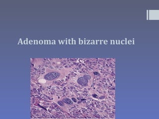 Adenoma with bizarre nuclei
 