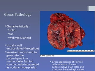 Gross Pathology


 Characteristically:
    solid
    tan
    well vascularized

 Usually well
  encapsulated throughout
 Invasive tumors tend to
  grow into the
  parenchyma in a
  multinodular fashion        Gross appearance of Hürthle
  (can be underinterpreted     cell carcinoma. The cut
  as nodular hyperplasia)      surface shows a tan color and
                               a necrotic hemorrhagic center
 