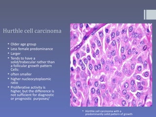 Hurthle cell carcinoma

  Older age group
  Less female predominance
  Larger
  Tends to have a
   solid/trabecular rather than
   a follicular growth pattern
   Cells:
  often smaller
  higher nucleocytoplasmic
   ratio
  Proliferative activity is
   higher, but the difference is
   not sufficient for diagnostic
   or prognostic purposes/


                                    Hürthle cell carcinoma with a
                                     predominantly solid pattern of growth
 