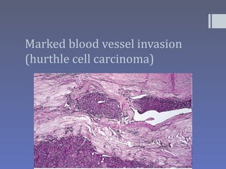 Marked blood vessel invasion
(hurthle cell carcinoma)
 