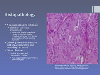 Histopathology

 A peculiar adenoma exhibiting:
   prominent trabecular
    arrangement:
     trabeculae may be straight or
      curved, resulting in in the
      cytoplasm of tumor cells due to
      accumulation of intermediate
      filaments
 Growth pattern may simulate
  that of paraganglioma and
  medullary carcinoma
 Distinct features:
   nuclear grooves and
    psammoma bodies:
     may suggest papillary carcinoma,
      particularly fine

                                          Hyalinizing trabecular adenoma. A wide trabecula
                                           is seen in the center of the picture, with the tumor
                                           cells arranged perpendicularly to the longest axis.
 