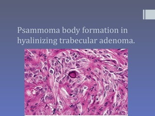 Psammoma body formation in
hyalinizing trabecular adenoma.
 