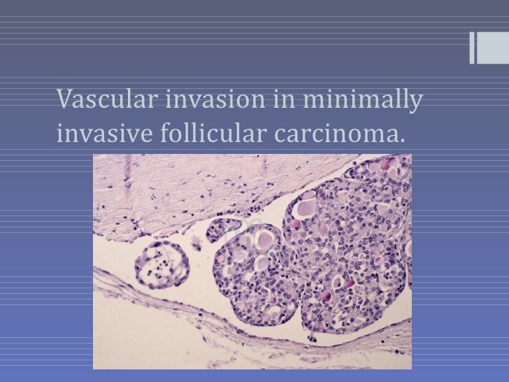 Minimally invasive thyroid cancer