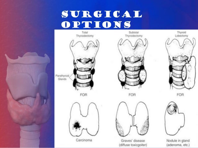 subtotal thyroidectomy