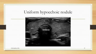 Thyroid nodule management