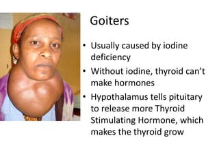 Goiters
• Usually caused by iodine
deficiency
• Without iodine, thyroid can’t
make hormones
• Hypothalamus tells pituitary
to release more Thyroid
Stimulating Hormone, which
makes the thyroid grow

 