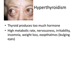 Hyperthyroidism

• Thyroid produces too much hormone
• High metabolic rate, nervousness, irritability,
insomnia, weight loss, exopthalmos (bulging
eyes)

 