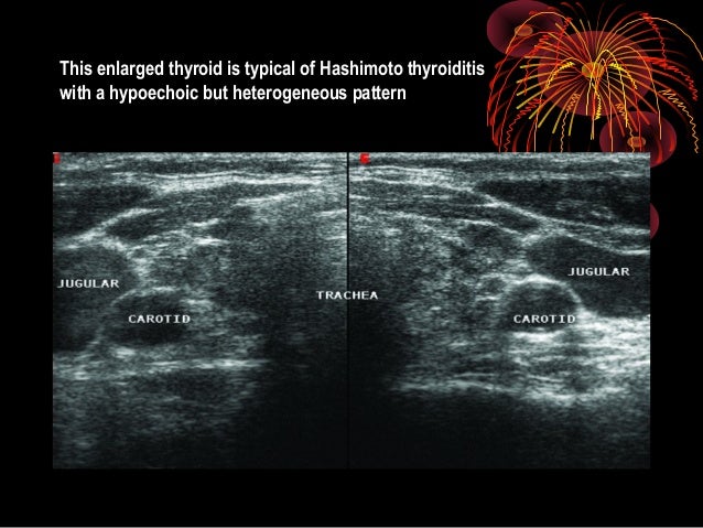 Thyroid ultrasound