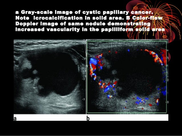 Thyroid ultrasound