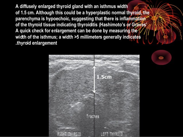 Thyroid ultrasound
