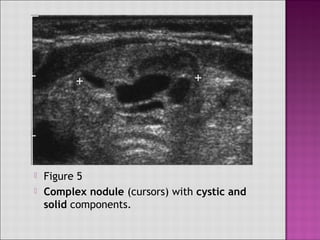  Figure 8
 Simple cyst (cursors) with no detectable wall
but with a large predominantly solid mural
nodule
 