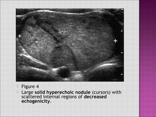  much more common than other types
 solid hypoechoic mass or tumor
 tiny microcalcifications noted
 hypervascularity
...