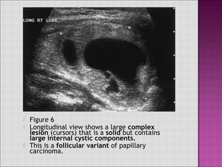  Figure 2
 Solid hypoechoic nodule (cursors) with a
prominent internal cystic component.
 