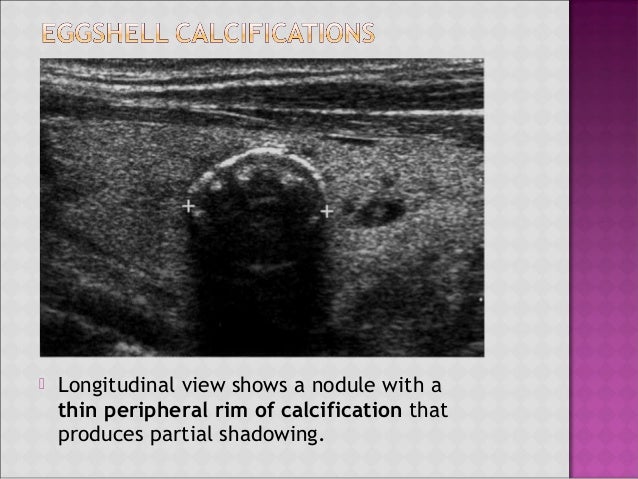Colloid thyroid nodule with calcium