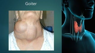 Goiter
 