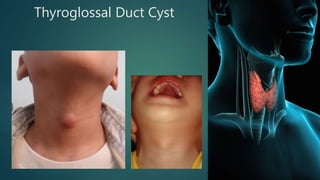 Thyroglossal Duct Cyst
 