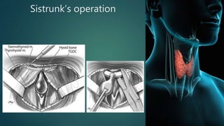 Sistrunk’s operation
 