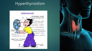 Hyperthyroidism
 