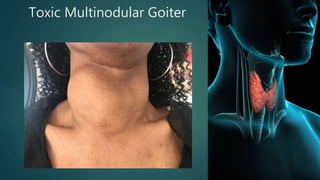 Toxic Multinodular Goiter
 