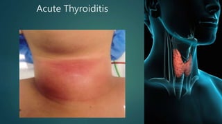 Acute Thyroiditis
 