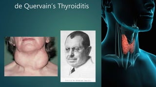 de Quervain’s Thyroiditis
 
