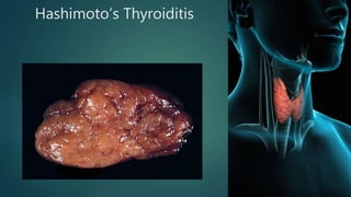 Hashimoto’s Thyroiditis
 