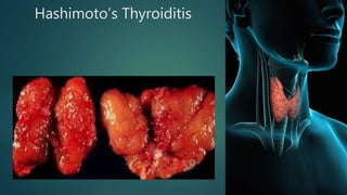 Hashimoto’s Thyroiditis
 