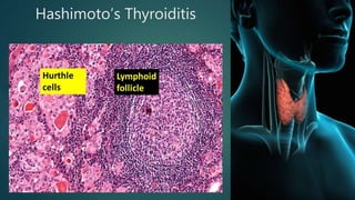 Hashimoto’s Thyroiditis
 