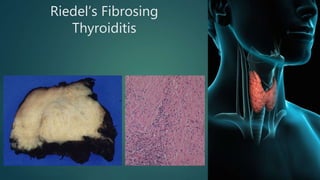 Riedel’s Fibrosing
Thyroiditis
 