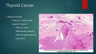 Thyroid Cancer
 Biopsy Findings:
 Follicular: Follicles with
capsular invasion
 FNA can never
differentiate between
follicular adenoma and
carcinoma
 