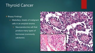 Thyroid Cancer
 Biopsy Findings:
 Medullary: sheets of malignant
cells in an amyloid stroma
 Neuroendocrine cell that
produce many types of
hormones (commonly
calcitonin)
 