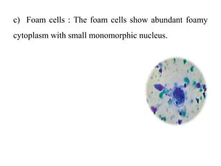 c) Foam cells : The foam cells show abundant foamy
cytoplasm with small monomorphic nucleus.
 