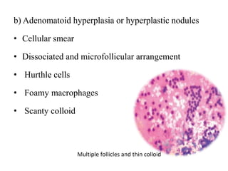 b) Adenomatoid hyperplasia or hyperplastic nodules
• Cellular smear
• Dissociated and microfollicular arrangement
• Hurthle cells
• Foamy macrophages
• Scanty colloid
Multiple follicles and thin colloid
 