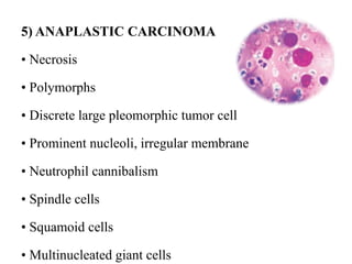 5) ANAPLASTIC CARCINOMA
• Necrosis
• Polymorphs
• Discrete large pleomorphic tumor cell
• Prominent nucleoli, irregular membrane
• Neutrophil cannibalism
• Spindle cells
• Squamoid cells
• Multinucleated giant cells
 