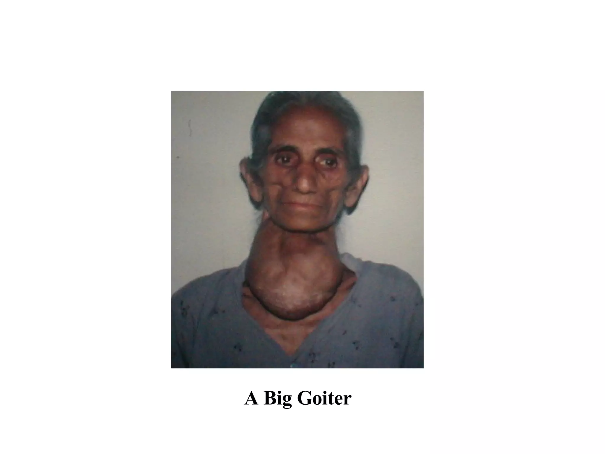 A Big Goiter